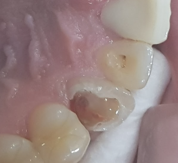 충치를 제거한 뒤 입천장 쪽에서 본 모습 — 치아 안쪽이 크게 파이고 잇몸선 아래까지 이어짐