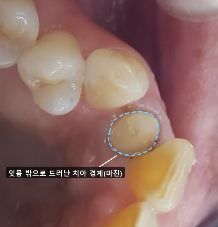 치관연장술 후 입천장 쪽에서 본 다듬은 치아 — 잇몸 밖으로 드러난 치아 경계를 하늘색 점선으로 표시한 모습