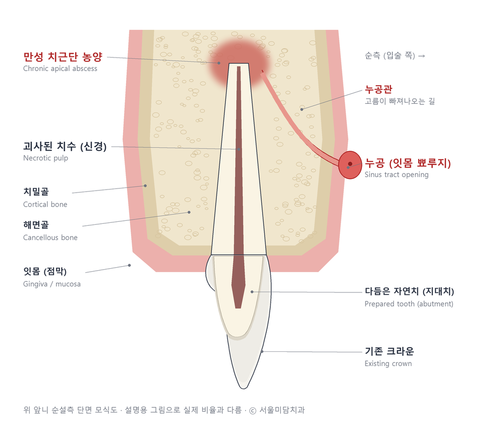 위 앞니 단면 모식도 — 기존 크라운 아래 괴사된 치수, 뿌리 끝 만성 치근단 농양, 고름 길(누공)을 따라 잇몸 뾰루지로 이어지는 모습
