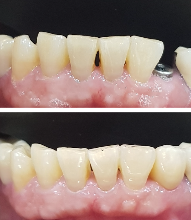 아래 송곳니 단일 임플란트 보철 전후 비교 — 위는 보철 전 힐링 어벗이 연결된 상태, 아래는 지르코니아 크라운을 올린 뒤