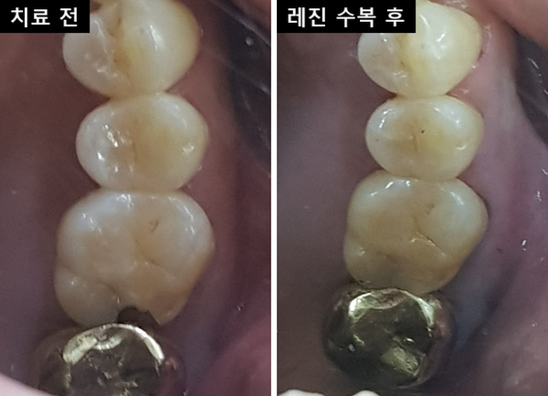 오른쪽 위 첫째 어금니 교합면 비교 — 왼쪽 치료 전 이웃 치아 쪽 모서리가 작게 깨진 모습, 오른쪽 레진 수복 후