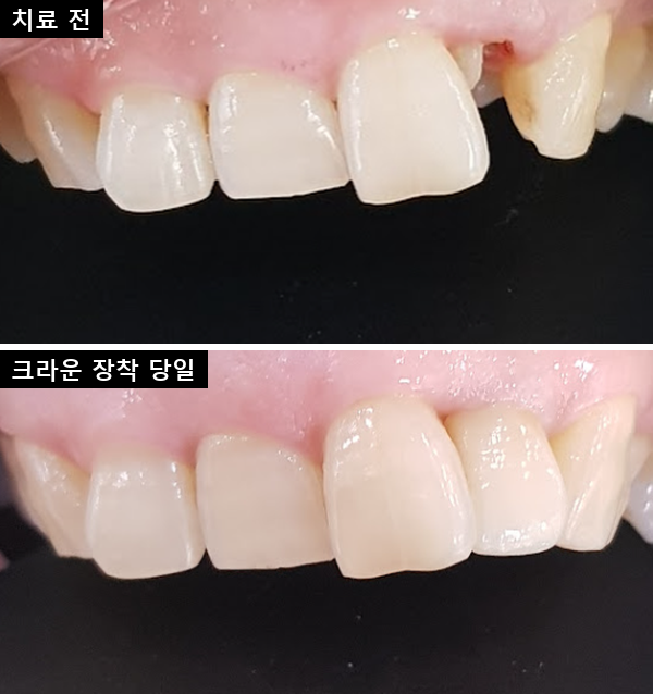 왼쪽 위 옆니 치료 전후 정면 — 위 치료 전, 아래 지르코니아 크라운 장착 당일