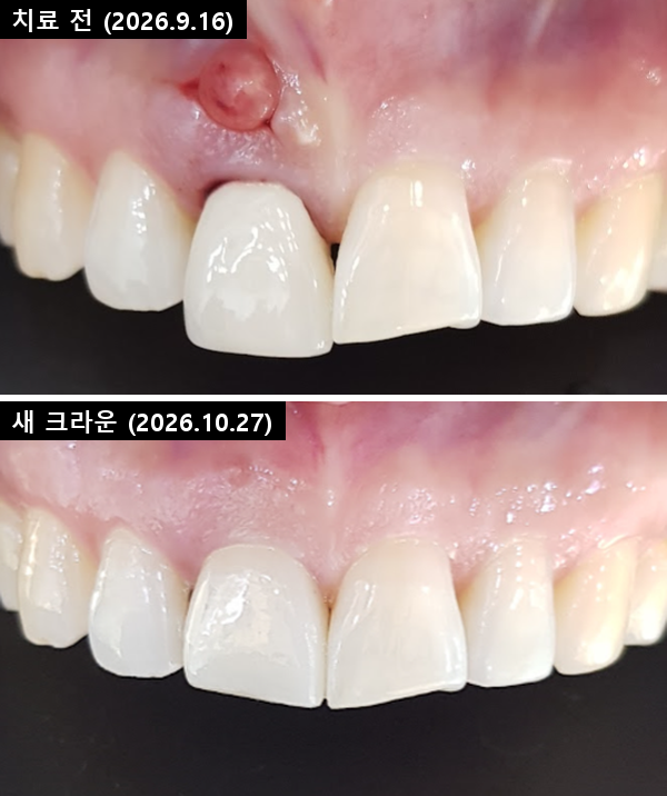 오른쪽 위 가운데 앞니 치료 전후 정면 — 위 치료 전 잇몸 뾰루지(누공), 아래 새 지르코니아 크라운을 씌운 날