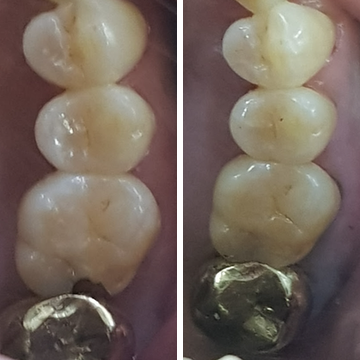 오른쪽 위 첫째 어금니 교합면 비교 — 왼쪽 치료 전, 오른쪽 레진 수복 후