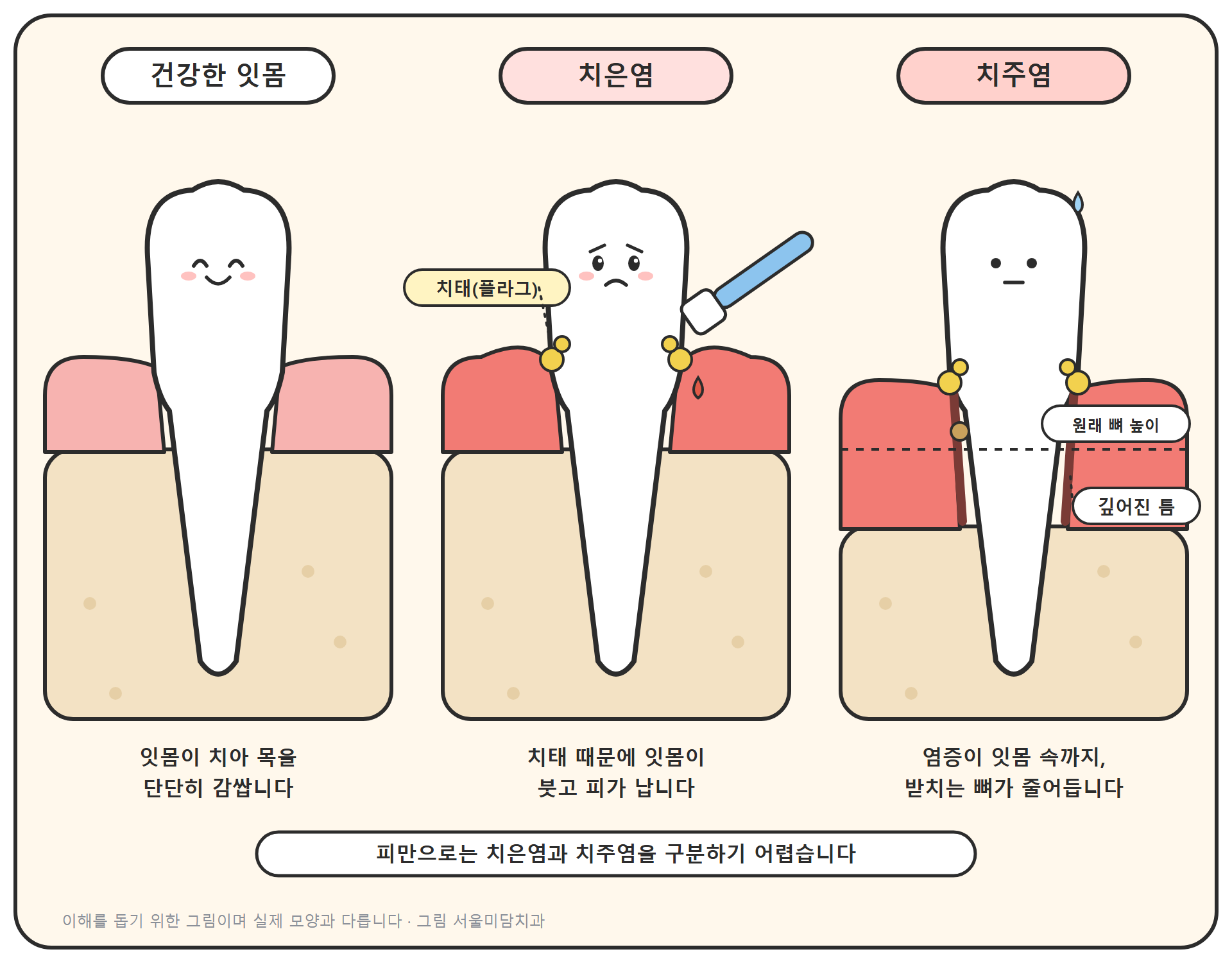건강한 잇몸, 치은염, 치주염을 나란히 그린 만화풍 단면 그림. 가운데 치은염은 치아와 잇몸 경계에 치태가 붙어 잇몸이 붉게 붓고 칫솔이 닿은 잇몸에 피가 맺혀 있다. 오른쪽 치주염은 잇몸과 치아 사이 틈이 깊어지고 치아를 받치는 뼈가 원래 높이보다 내려가 있다