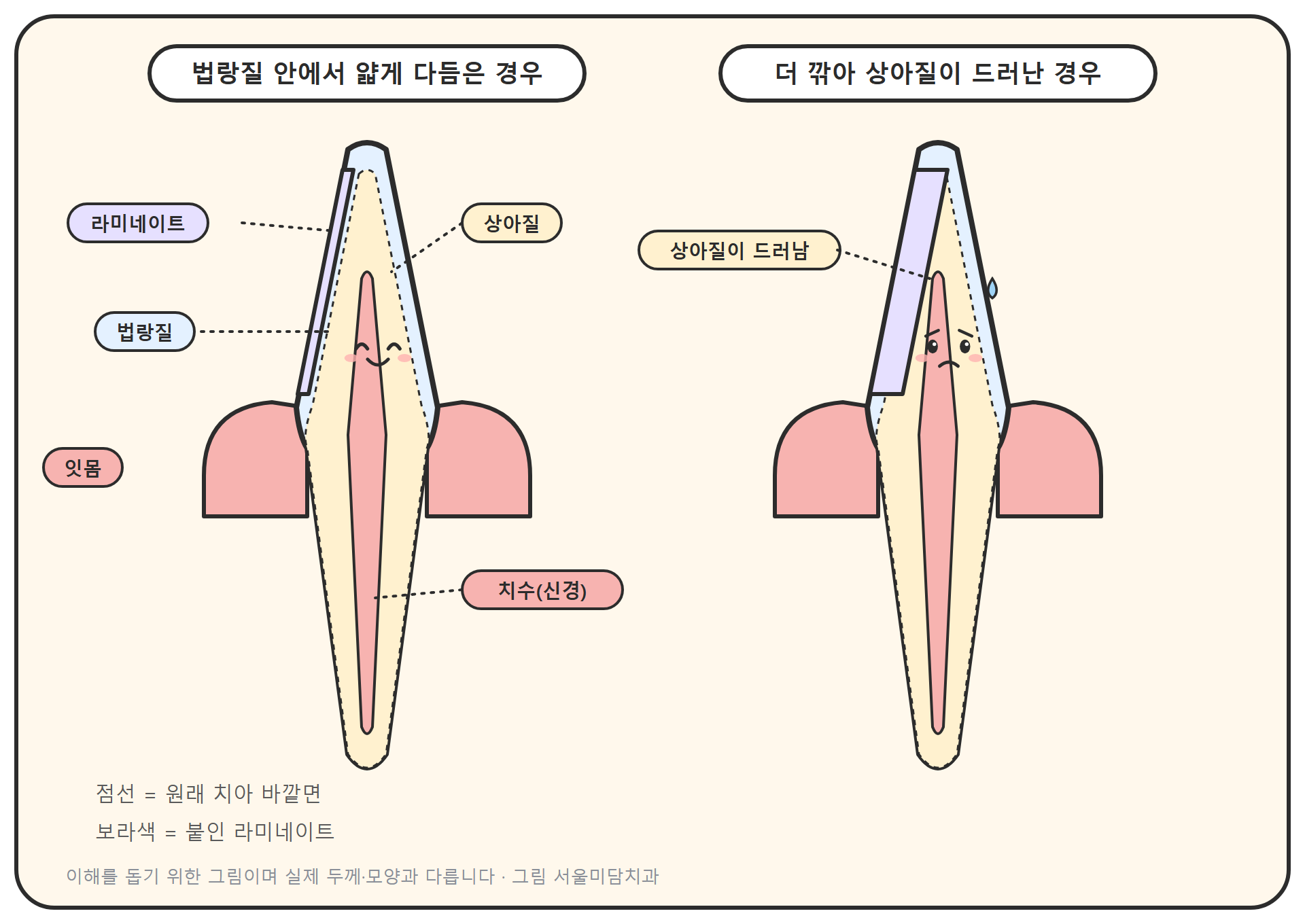 앞니 단면 모식도. 바깥 법랑질 안에서 얇게 다듬은 경우와, 더 깎아 안쪽 상아질이 드러난 경우를 나란히 비교하고 그 위에 라미네이트가 붙는 위치를 표시했다