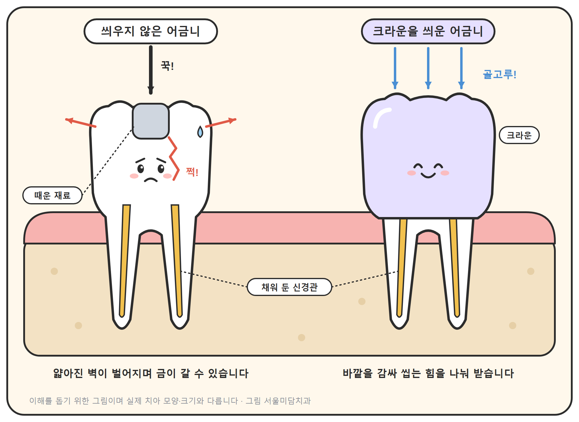 신경치료한 어금니 두 개를 비교한 만화풍 단면 그림. 왼쪽은 씌우지 않은 어금니로, 가운데를 때운 재료로만 막아 두어 씹는 힘에 벽이 바깥으로 벌어지며 금이 간다. 오른쪽은 크라운이 치아 바깥을 감싸 힘이 고르게 퍼진다