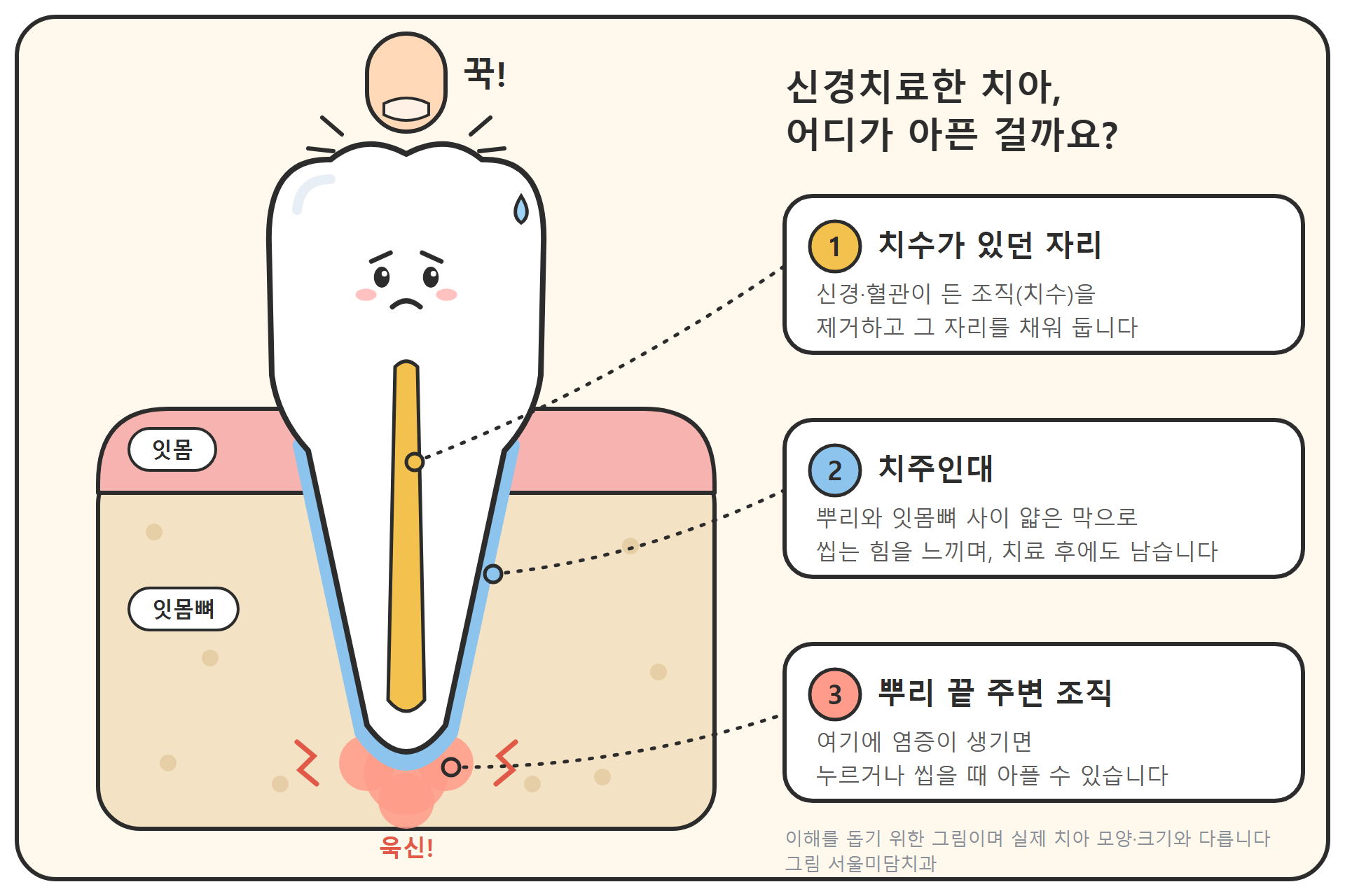 신경치료한 치아의 단면 모식도. 치수가 있던 자리는 채워져 있고, 뿌리를 둘러싼 치주인대와 뿌리 끝 주변 조직은 그대로 남아 있다