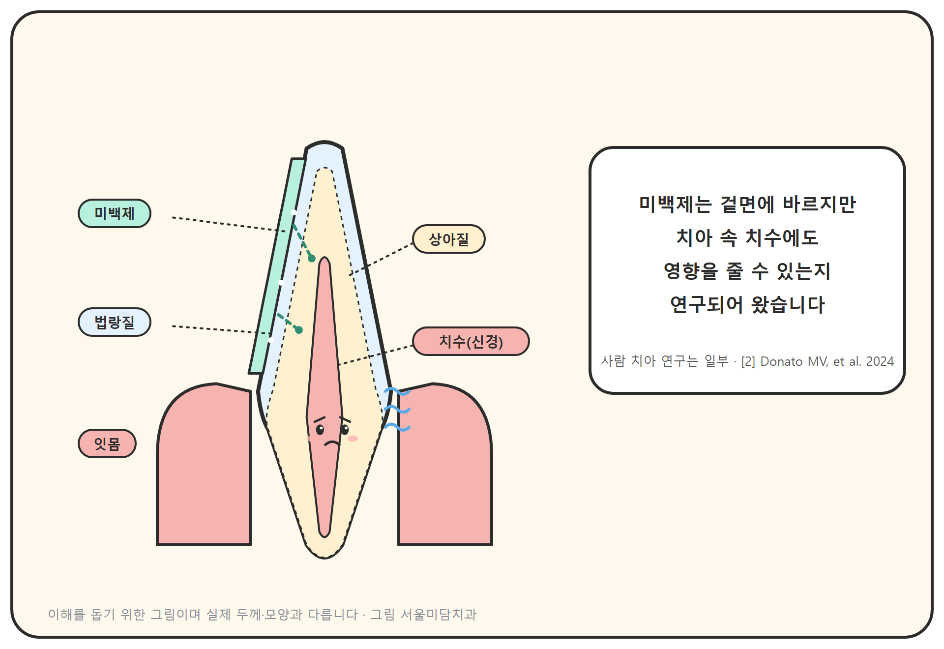 미백제가 치아 겉면 법랑질에 발려 있고, 안쪽 상아질을 지나 치수 쪽으로 점선이 이어지는 치아 단면 모식도. 치수 부분에 시린 표정이 그려져 있다